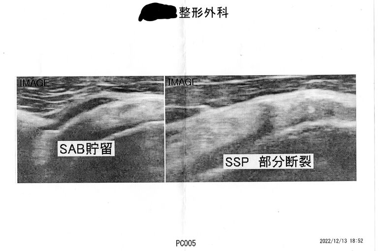 腱板断裂
